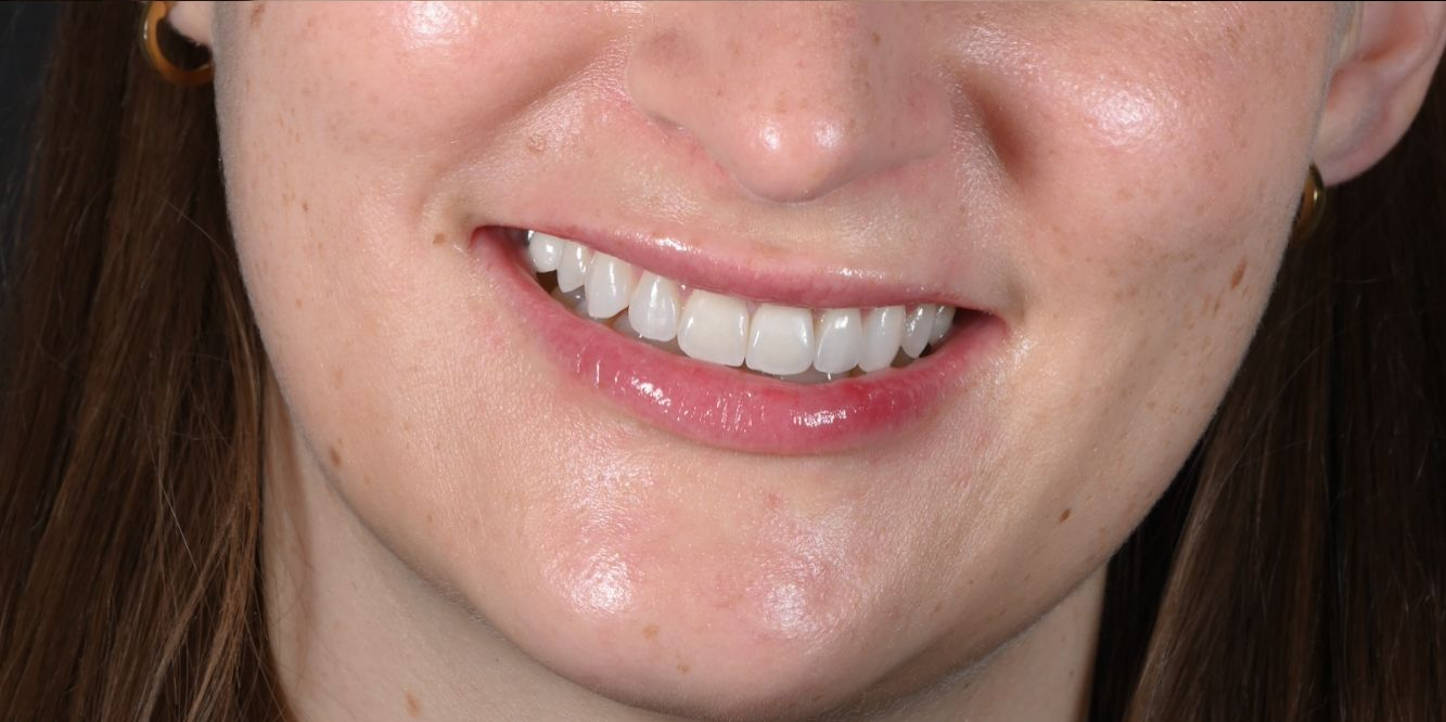 Patient smile before and after treatment — After