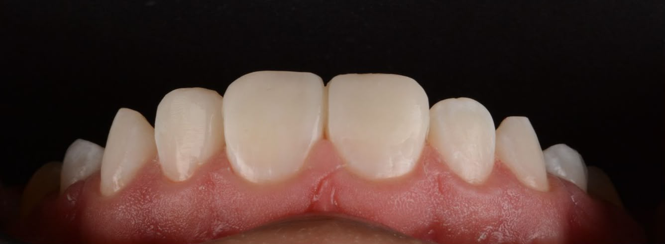 Close-up of a bonded, natural-looking smile