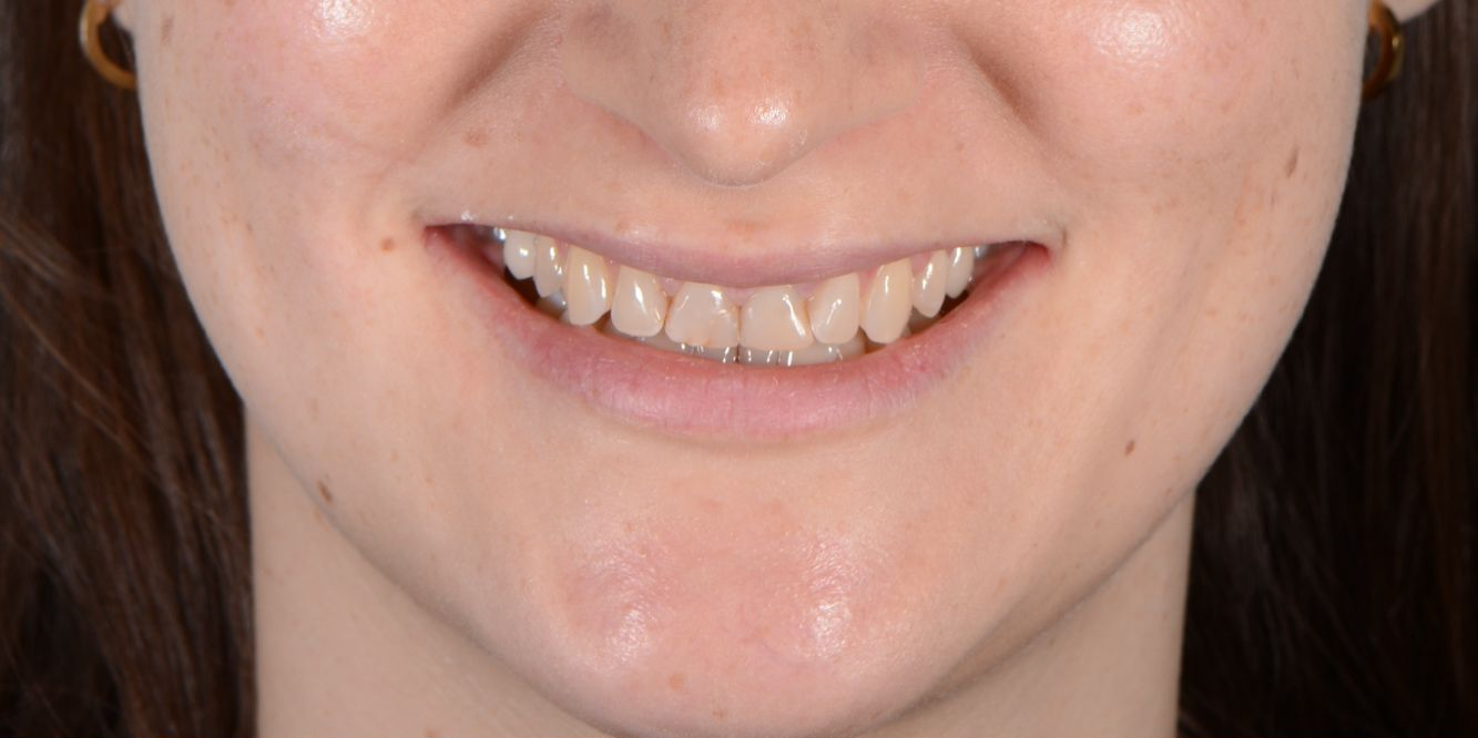Patient smile before and after treatment — Before