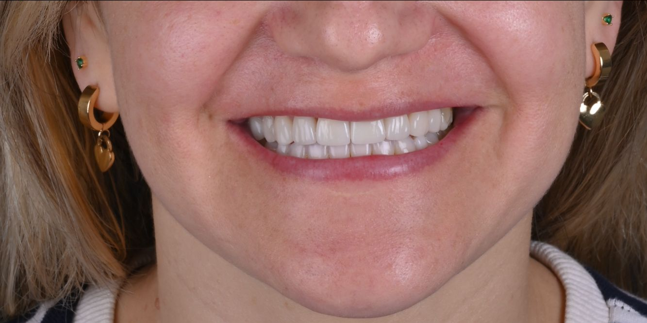 Patient smile before and after treatment — After