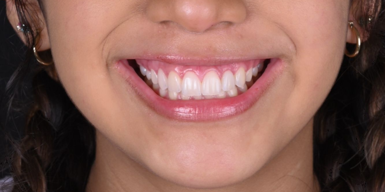 Patient smile before and after treatment — After