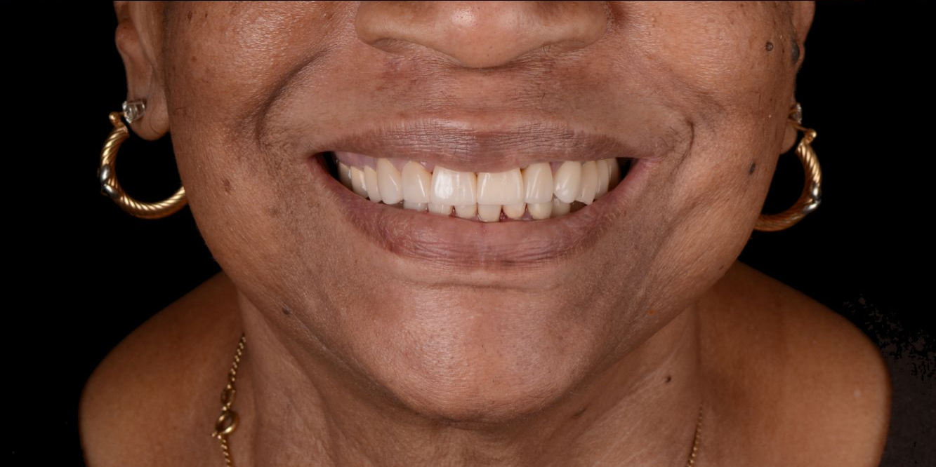 Patient smile before and after treatment — After