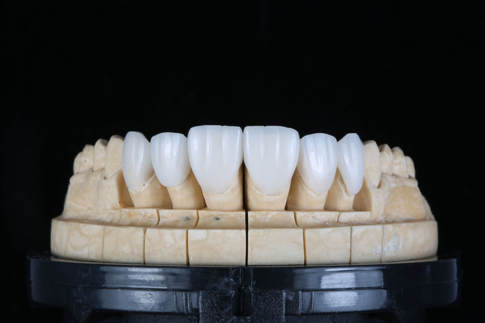 Porcelain veneer samples
