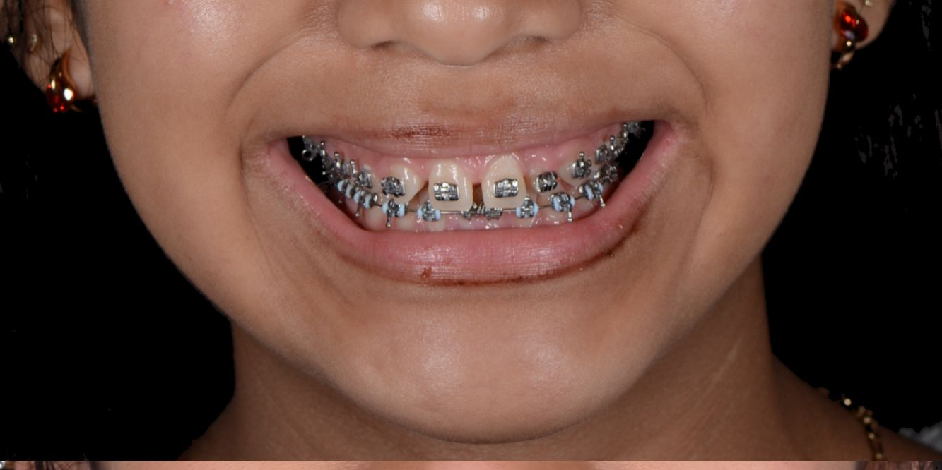 Patient smile before and after treatment — Before