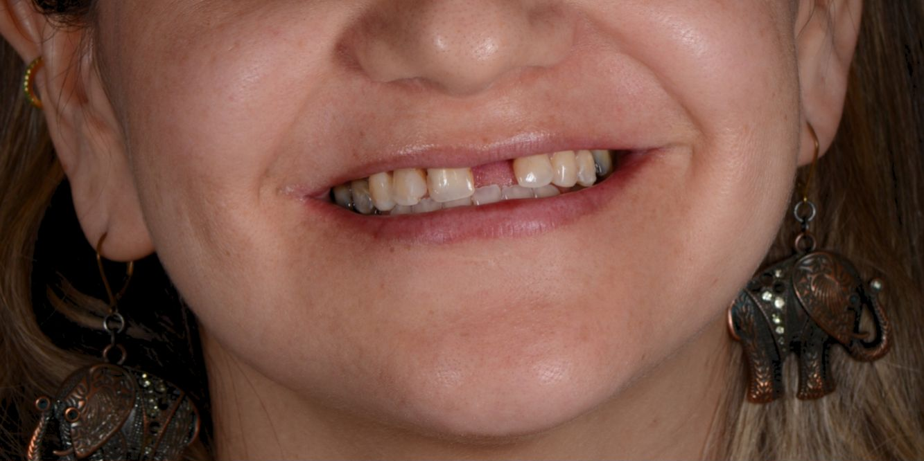 Patient smile before and after treatment — Before
