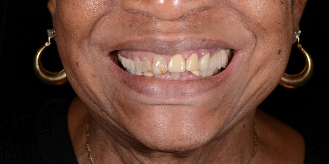 Patient smile before and after treatment — Before